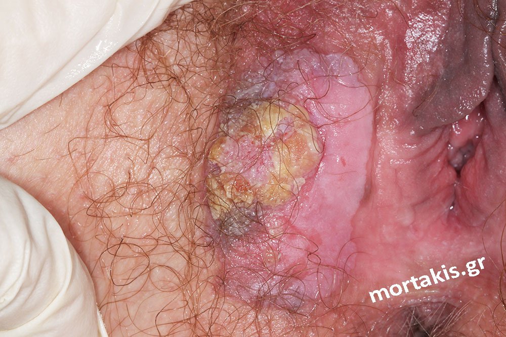 VIN-Vulvar-Intraepithelial-Neoplasia-Bowen-Vulvar-HSIL