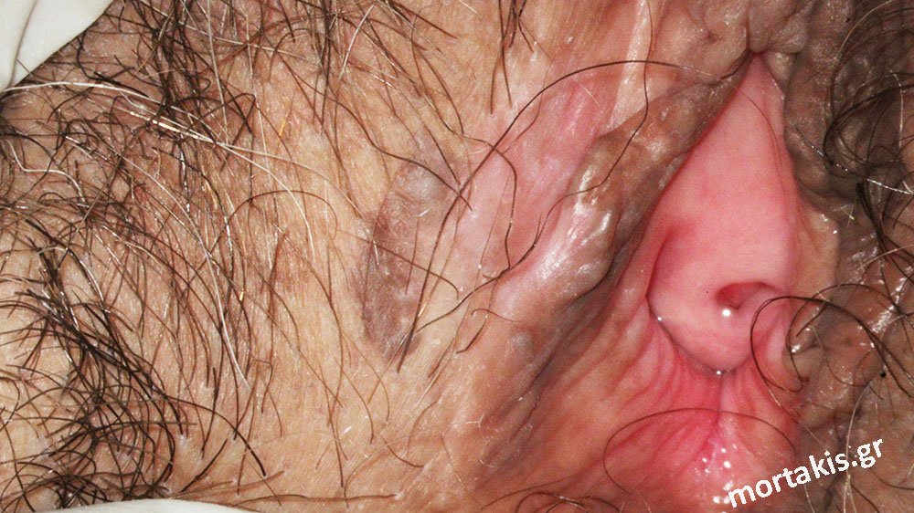VIN-Vulvar-Intraepithelial-Neoplasia-Bowen-Vulvar-HSIL