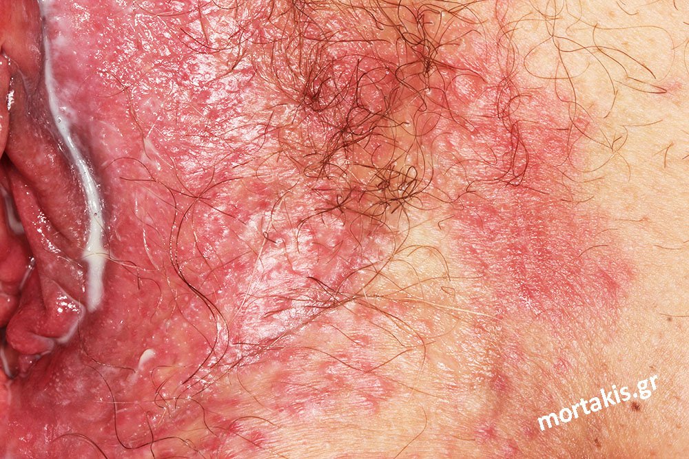 Vulvovaginitis-Αιδοιοκολπίτιδα