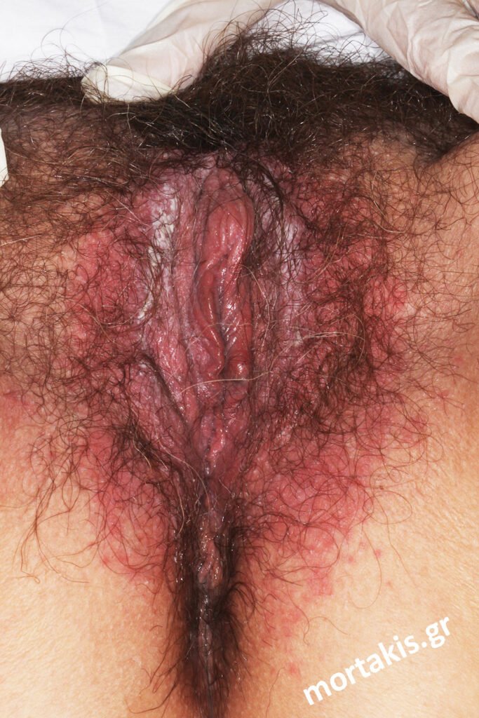 Vulvovaginitis-Αιδοιοκολπίτιδα