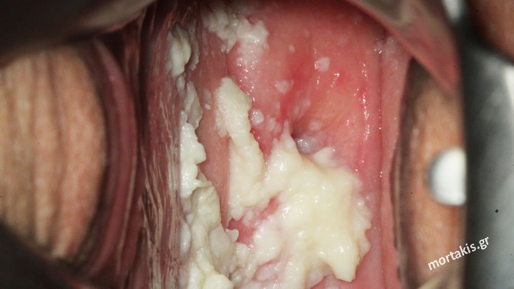 candidiasis-μυκητιασική-κολπίτιδα