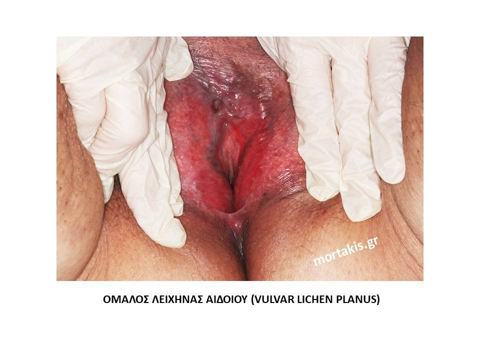 Ομαλος-Λειχήνας-Αιδοίου-Vulvar-Lichen-Planus