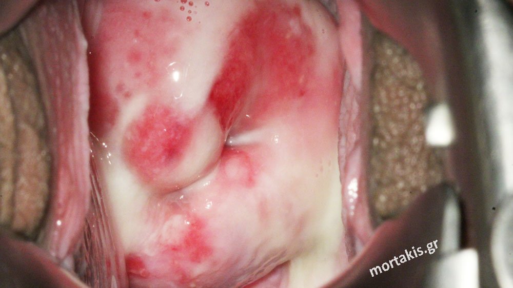 βακτηριακή-αναερόβια-κολπίτιδα-bacterial-vaginosis