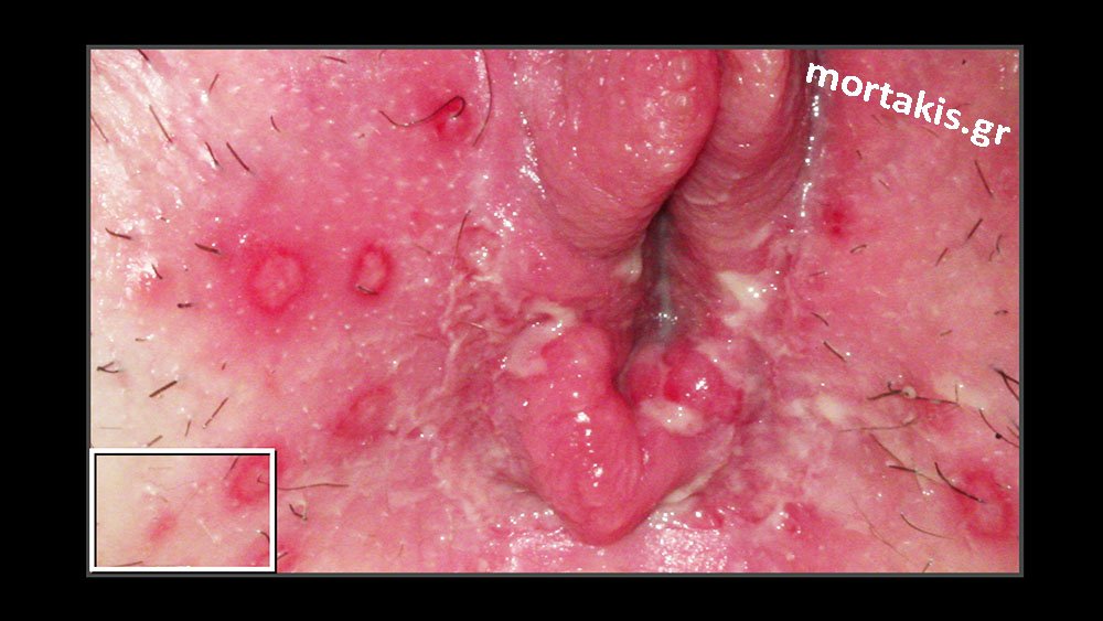 Έρπητας-Γεννητικών-οργάνων-Herpes-genitalis