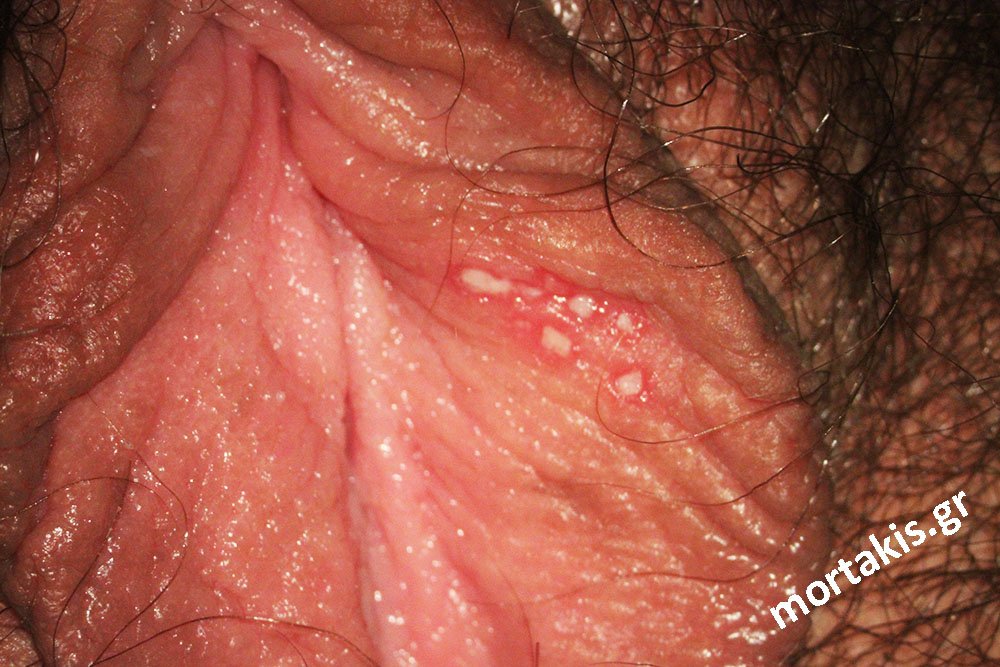 Έρπητας-Γεννητικών-οργάνων-Herpes-genitalis