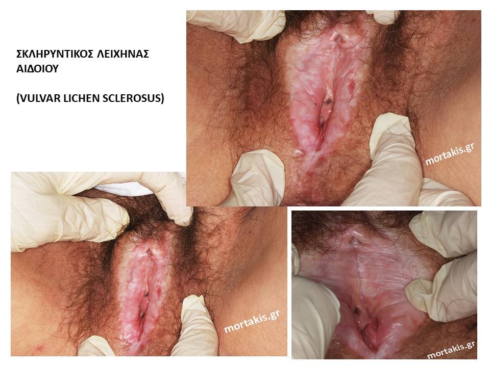 Σκληρυντηκός-Λειχήνας-Αιδοίου-Vulvar-Lichen-Sclerosus-2