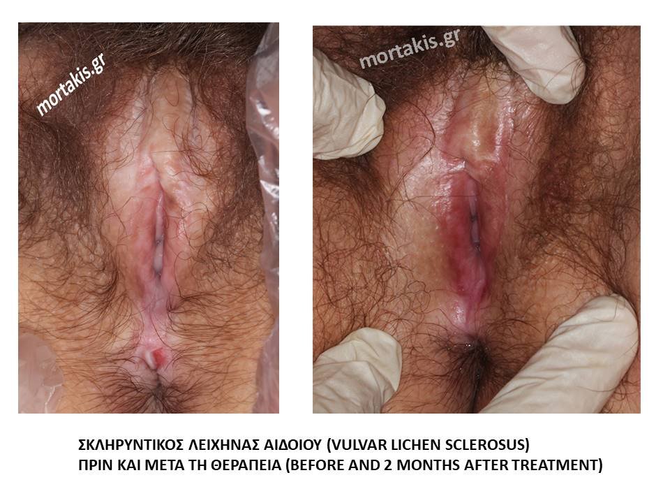 Σκληρυντηκός-Λειχήνας-Αιδοίου-Vulvar-Lichen-Sclerosus