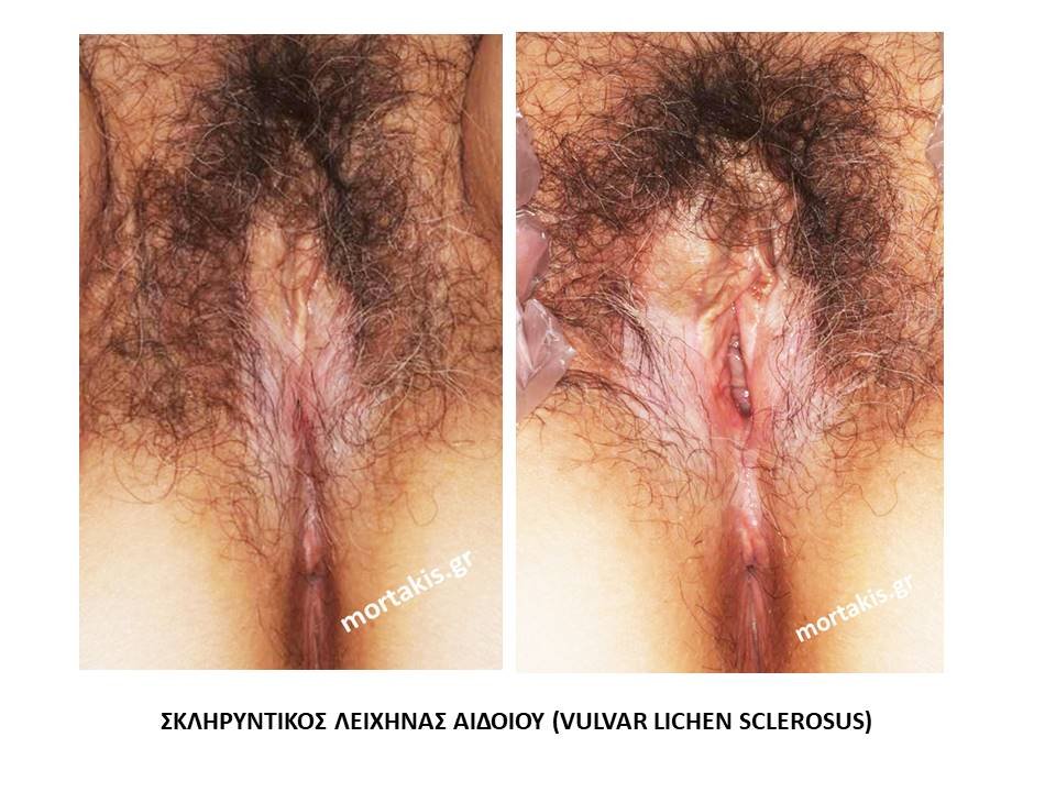 Σκληρυντηκός-Λειχήνας-Αιδοίου-Vulvar-Lichen-Sclerosus