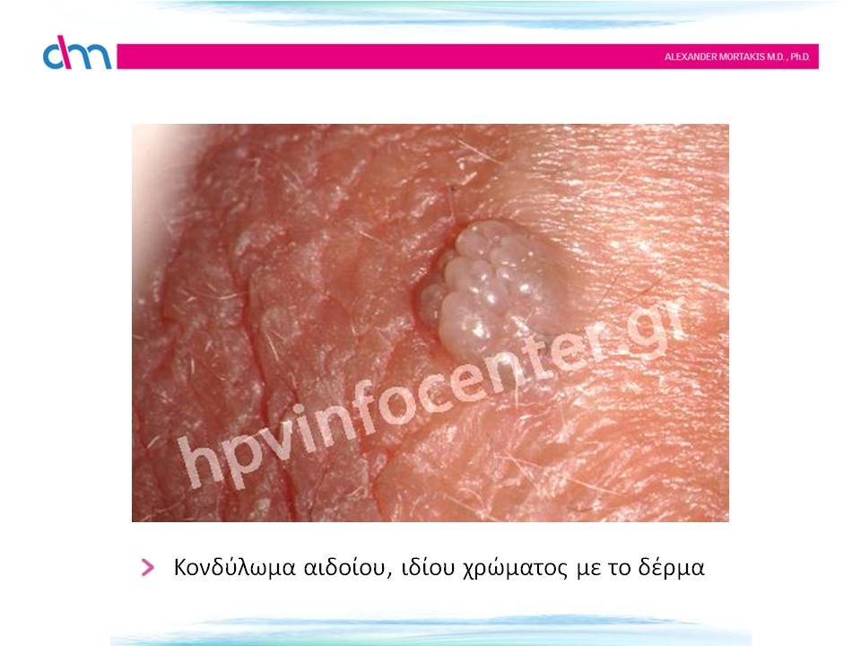 κονδυλώματα αιδοίου - warts