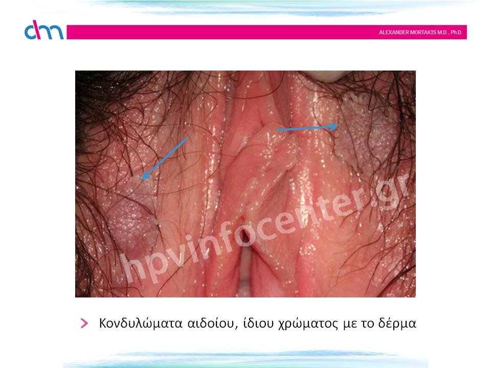 κονδυλώματα αιδοίου - warts