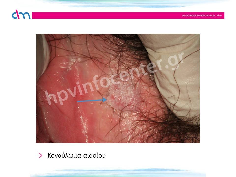 κονδυλώματα αιδοίου - warts