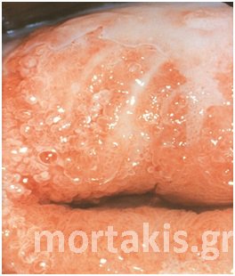 colposcopy
