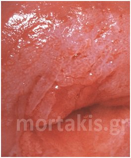 colposcopy