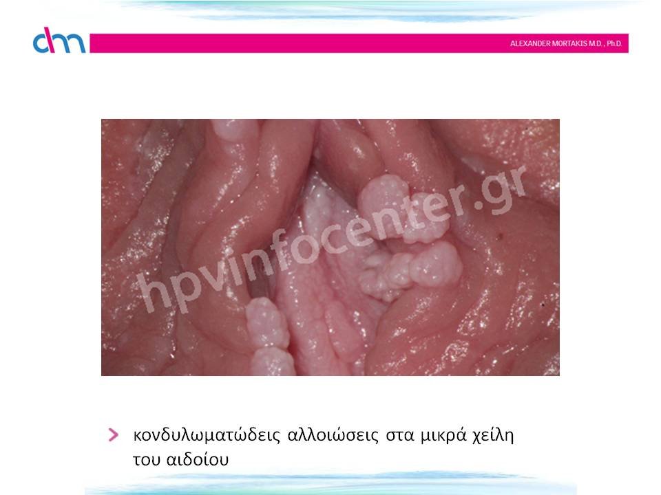 κονδυλώματα χείλη αιδοίου - warts