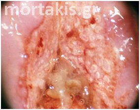 cervical cancer