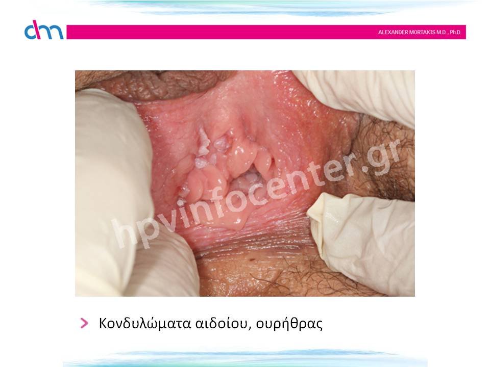 κονδυλώματα αιδοίου, ουρήθρας - warts
