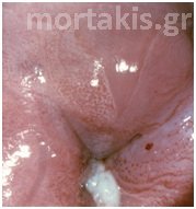 colposcopy