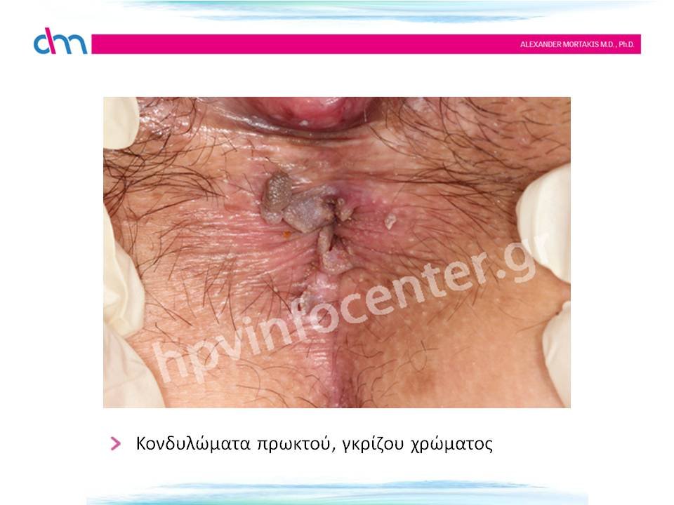 anal warts - κονδυλώματα πρωκτού