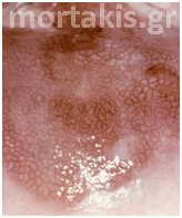colposcopy