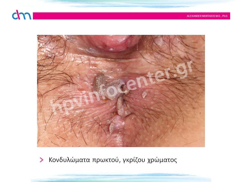 anal warts - κονδυλώματα πρωκτού