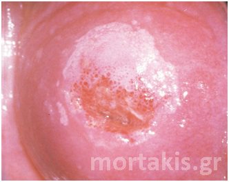 HPV - LSIL