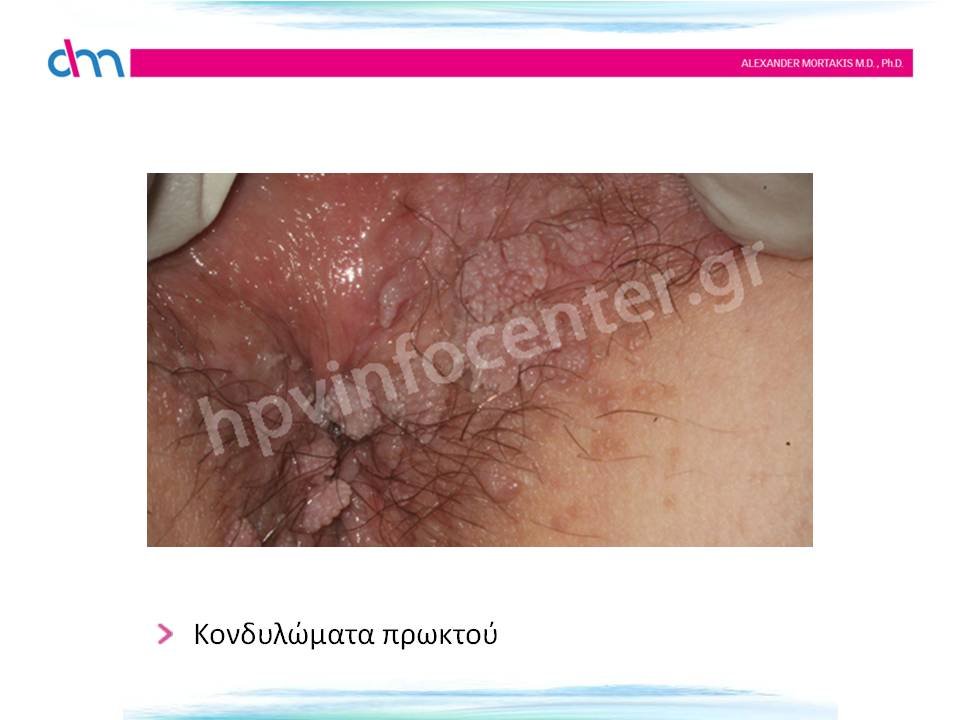 anal warts - κονδυλώματα πρωκτού