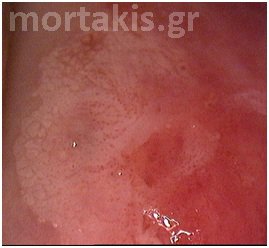 colposcopy