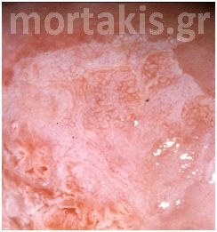 HPV - LSIL