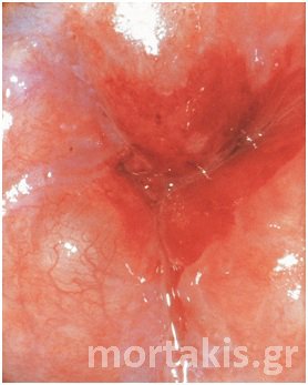 colposcopy