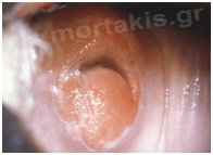 cervix