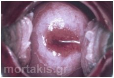 cervix