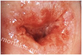 hpv
