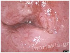 hpv