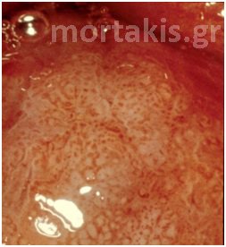 HPV - HSIL