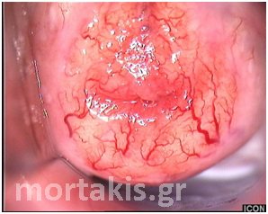 colposcopy