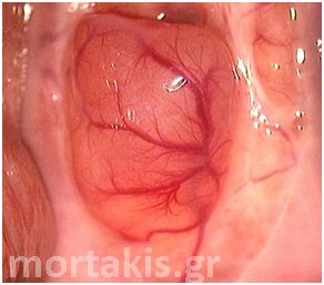 colposcopy
