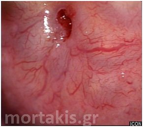 colposcopy