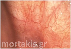 colposcopy