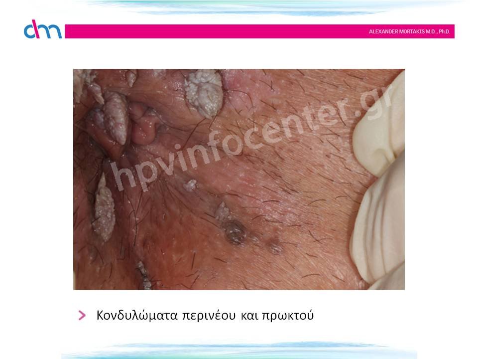anal warts - κονδυλώματα πρωκτού και περινέου