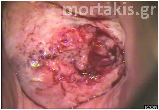 cervical cancer