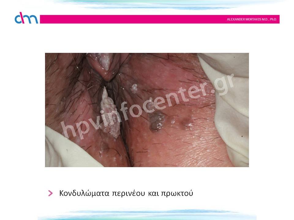 anal warts - κονδυλώματα πρωκτού και περινέου