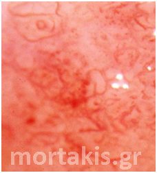 colposcopy