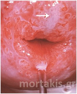 hpv
