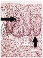 colposcopy