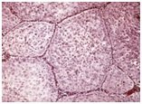 colposcopy