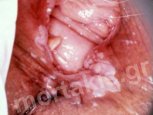 HPV - VIN