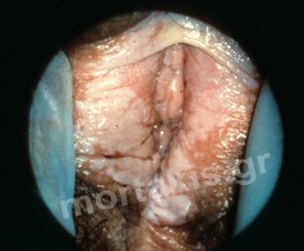 HPV - VIN