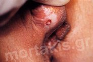 HPV - VIN