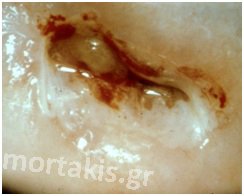 hpv