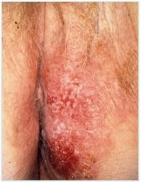 HPV - VIN